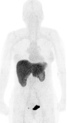 Exemplar 1 image - [18F]FPIA maximum intensity projection (MIP) image showing normal biodistribution in a healthy volunteer. Note minimal background activity aside from liver.