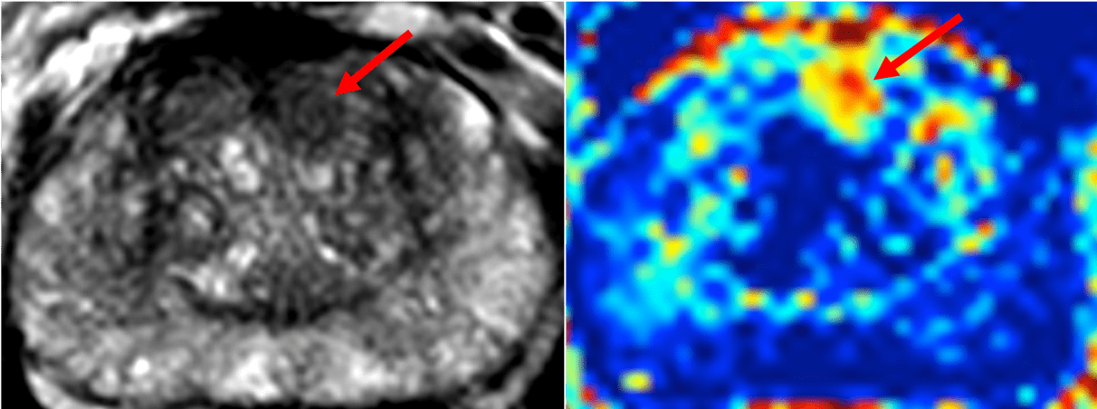 NCITA exemplar 4 image - MRI imaging of patient with biopsy proven prostate cancer. The left image is an axial T2-weighted MRI image showing a homogenous low signal area in the left anterior para-midline transition zone of the prostate. The right image is a novel VERDICT (Vascular, Extracellular and Restricted Diffusion for Cytometry in Tumours) MRI map at the same level showing a focal area (arrow) with increased intracellular volume fraction, which enables clearer definition of the tumour area.