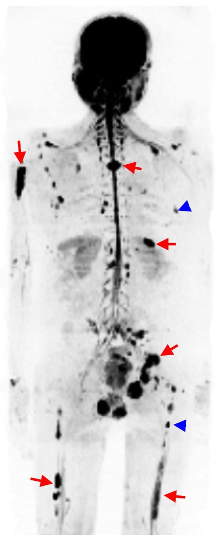 NCITA exemplar 3 image - Inverted greyscale whole body MR image in a patient with multiple myeloma showing multiple sites of disease appearing as dark areas across the skeleton. Whole body MRI has exquisite sensitivity for detecting both larger foci of disease (red arrows), as well as smaller lesions less than 5 mm in size (blue arrowheads), thus improving disease detection and enhancing management decisions.