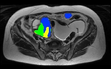 MRI and PET CT scan showing imaging habitats in ovarian tumour (Credit Evis Sala University of Cambridge)