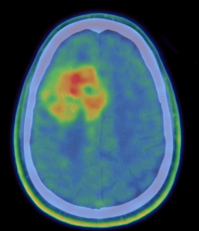 NCITA Example 18F-DOPA imaging showing heterogeneous uptake within the tumour in the brain of a glioma patient